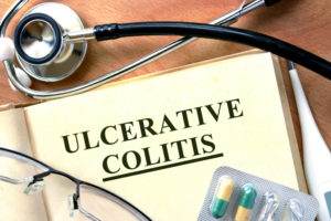 Treatment of ulcerative colitis